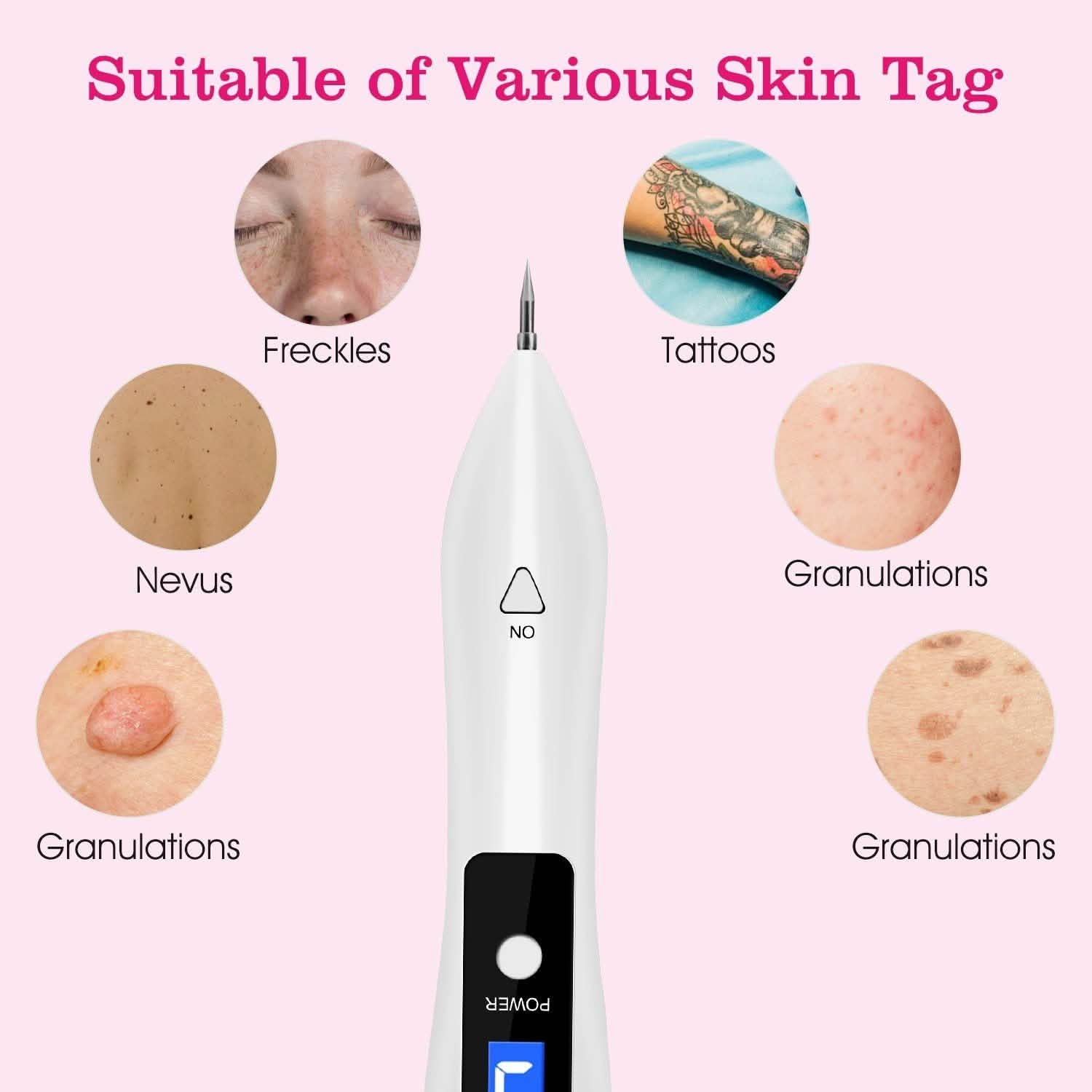 Portable Skin Tag Repair Kit with 6 Replaceable Needles by DailySale